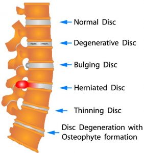 Degenerative Disc Disease- Herniated Disc