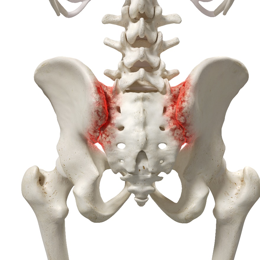 Sacroiliac Joint Inflammation- Arthritis