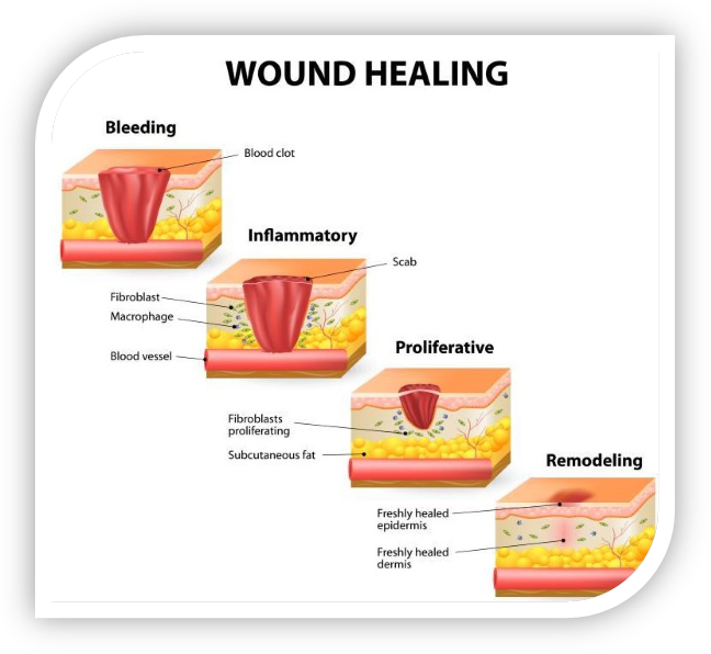 Stages of wound healing