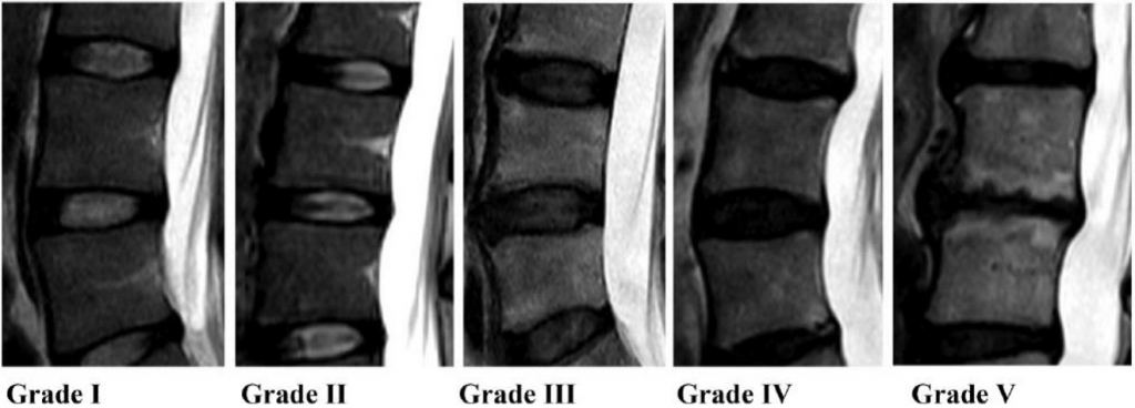 Cell Therapy for Herniated Disc - ACIDTA
