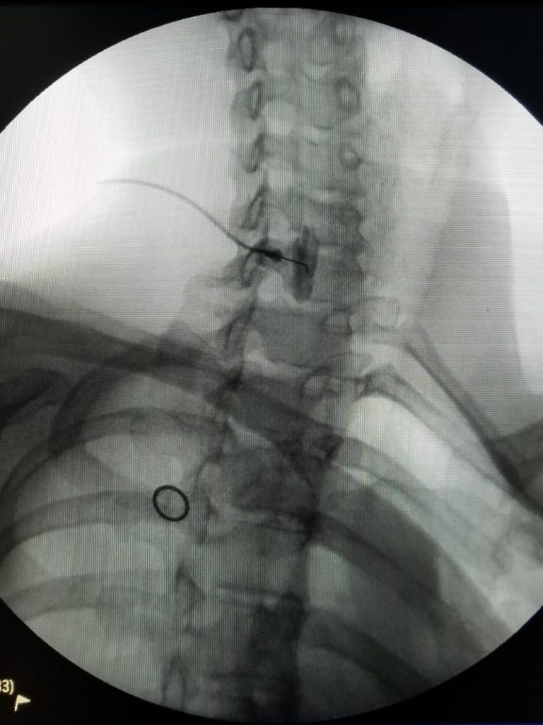 Stellate Ganglion Block For PTSD. - Cornell Pain Clinic