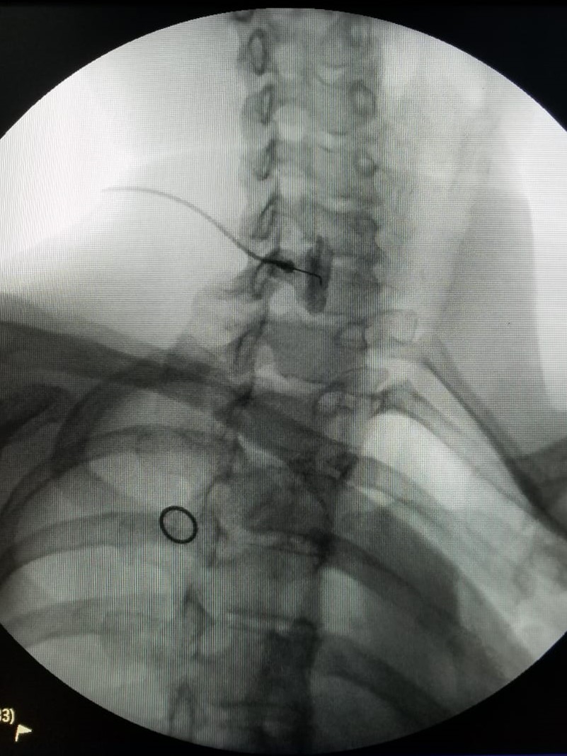 Stellate Ganglion Block For Ptsd Cornell Pain Clinic