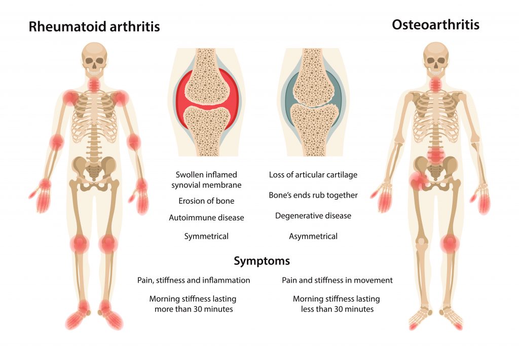 Arthritis Related Pain Cornell Pain Clinic